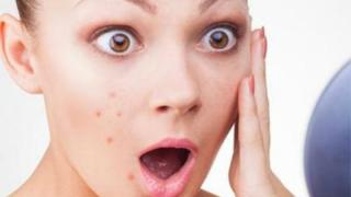 Ακμή: O εφιάλτης της εφηβείας ή μήπως όχι;