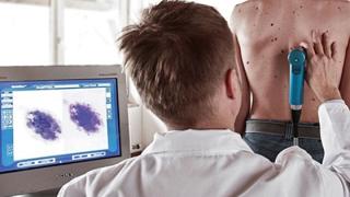 Σπίλοι (ελιές) του δέρματος: Όλα όσα πρέπει να ξέρουμε άμεσα