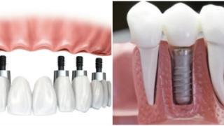 Είσαι... "φαφούτης" και ντρέπεσαι να χαμογελάσεις; Σου έχουμε τη λύση