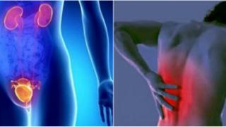 Νεφρολιθίαση: Υποφέρετε κι εσείς από κολικούς νεφρού;