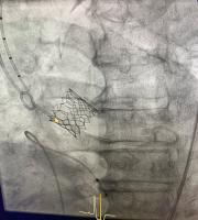 "Τα έβγαλε εις πέρας" σε μια δύσκολη επέμβαση η Πανεπιστημιακή Καρδιολογική Κλινική του ΠΓΝΑ!