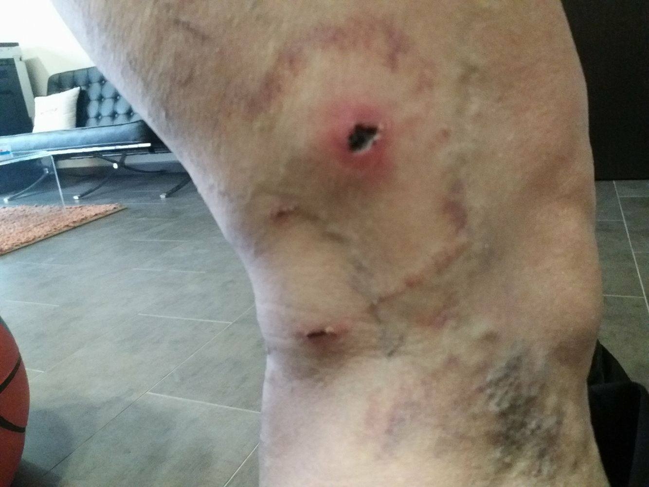 Στη φωτογραφία φαίνεται πως είναι το δάγκωμα, μετά από αρκετές μέρες