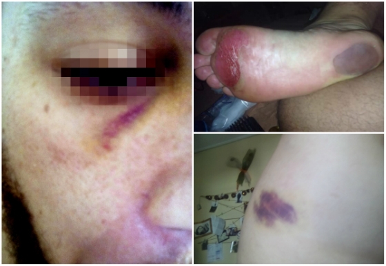 Οι μώλωπες του 27χρονου από τον ξυλοδαρμό του στη Σαμοθράκη